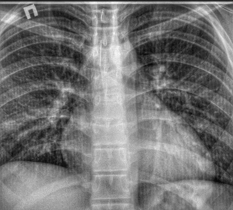 Застрягла прямо у трахеї: в Одеській області підліток випадково вдихнув шпильку
