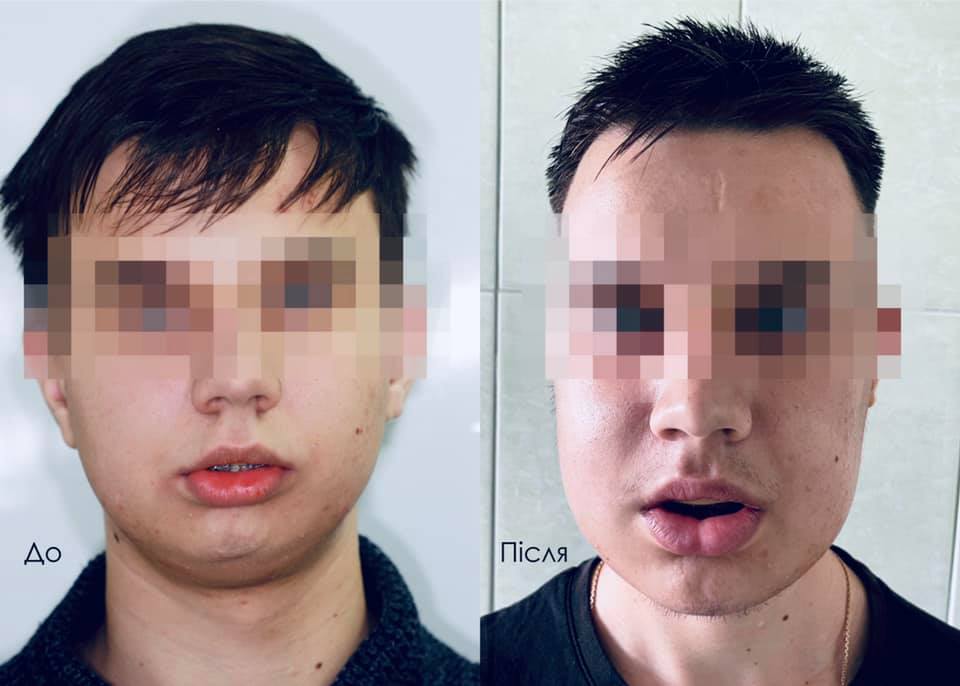 Украинские врачи заново собрали лицо молодому парню: фото до и после