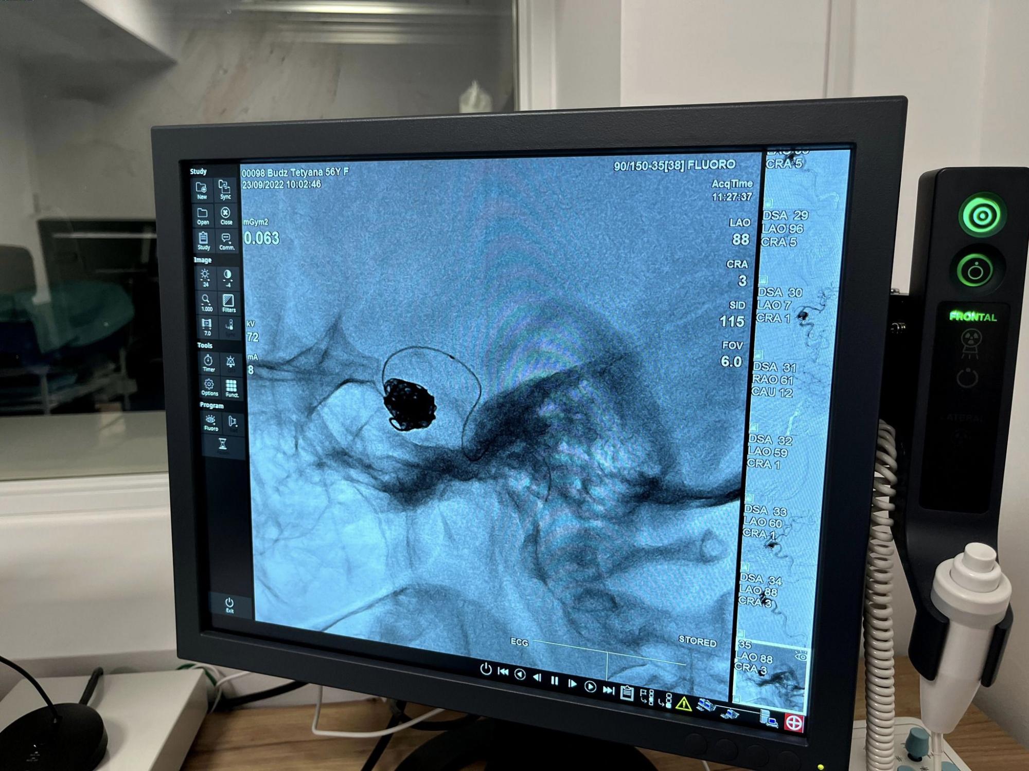 Ні одного розрізу: українські медики врятували життя жінці з величезною аневризмою