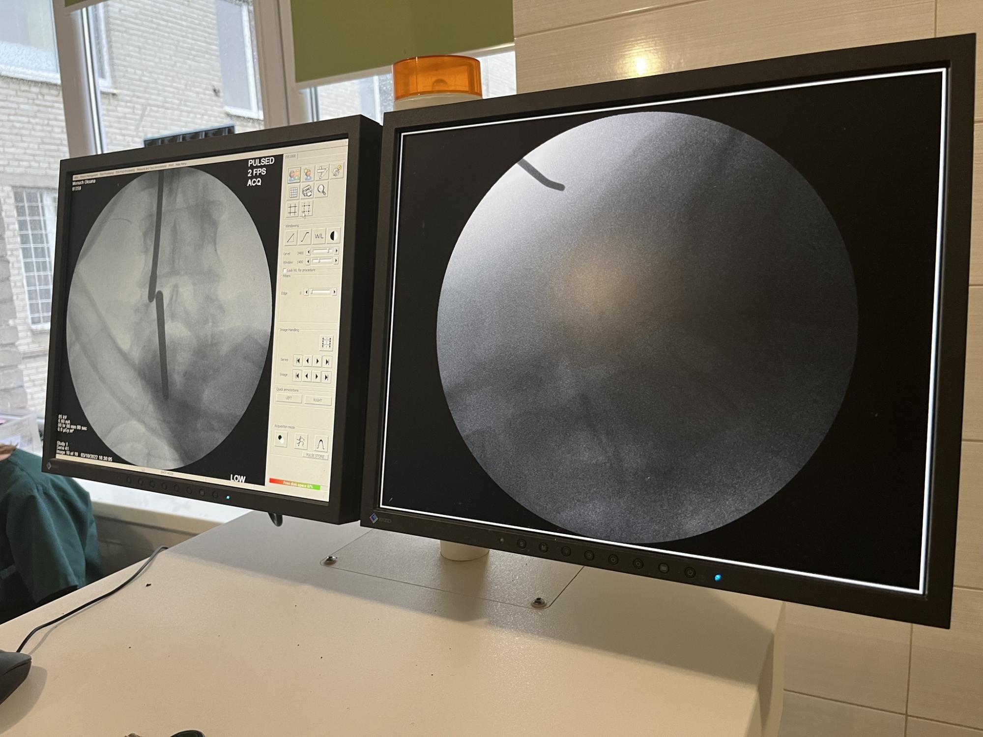 Через несколько часов пациентка уже ходила: во Львове врачи провели уникальную операцию на позвоночнике