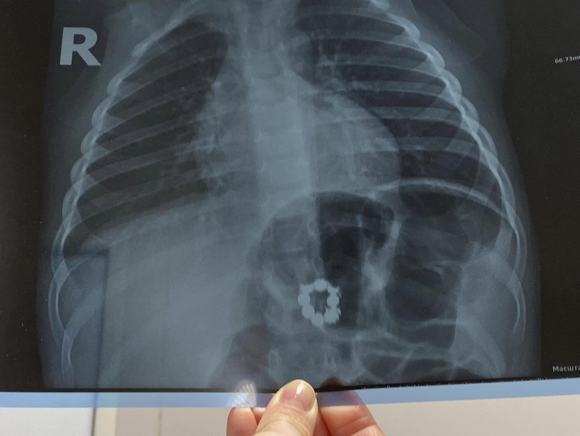 У Києві 3-річний хлопчик проковтнув магніти і місяць жив із ними: батьки не здогадувалися