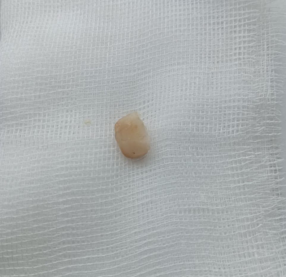 Прожила із зубом у бронхах понад півроку: лікарям у Львові вдалося врятувати жінку