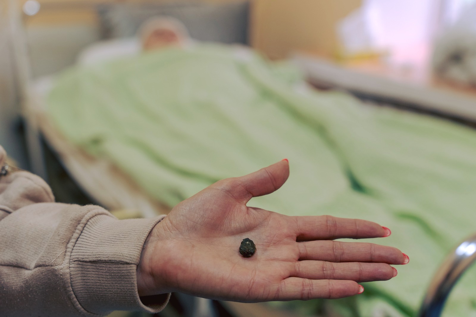 &quot;Сантиметровий уламок застряг у мозку&quot;: лікарі дивом врятували постраждалу в Умані