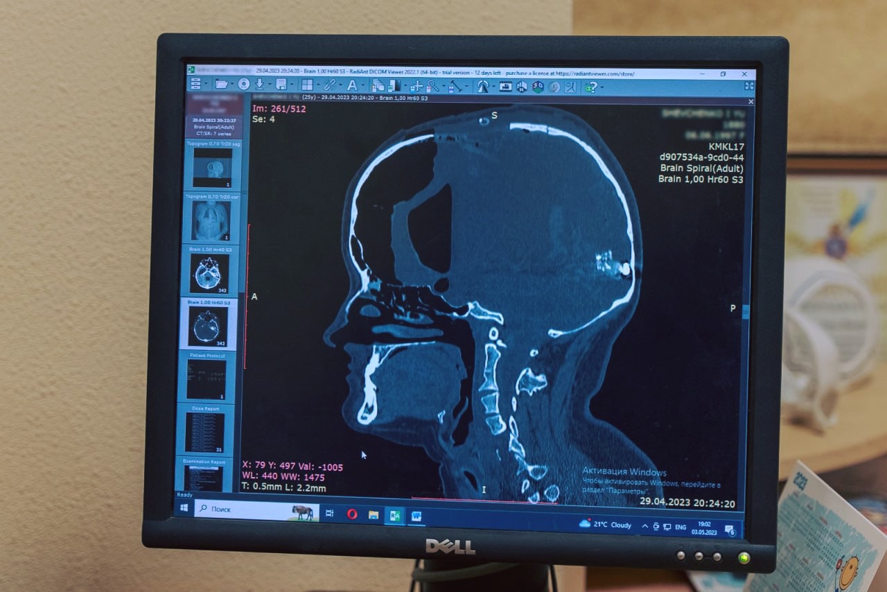 &quot;Сантиметровий уламок застряг у мозку&quot;: лікарі дивом врятували постраждалу в Умані