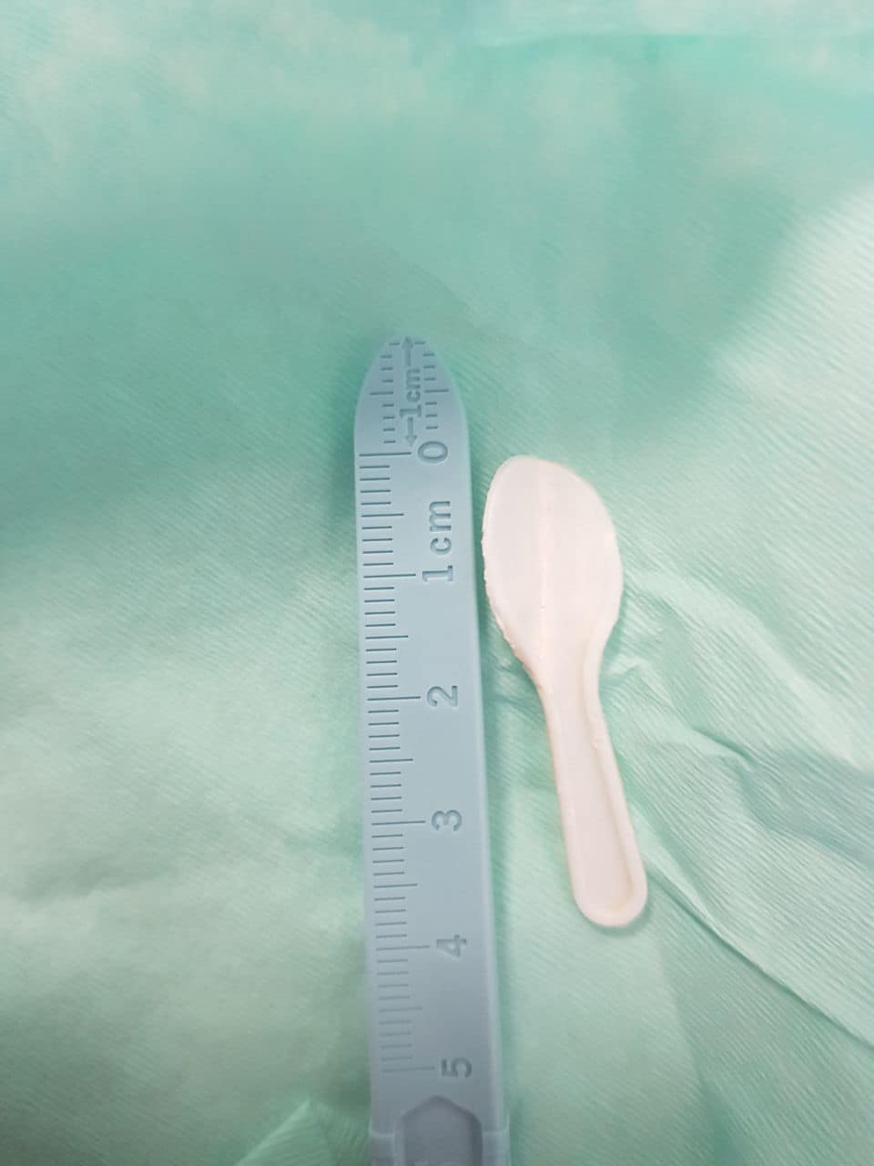 В Україні в організмі дитини виявили ложку, яка знаходилась там кілька місяців (фото)