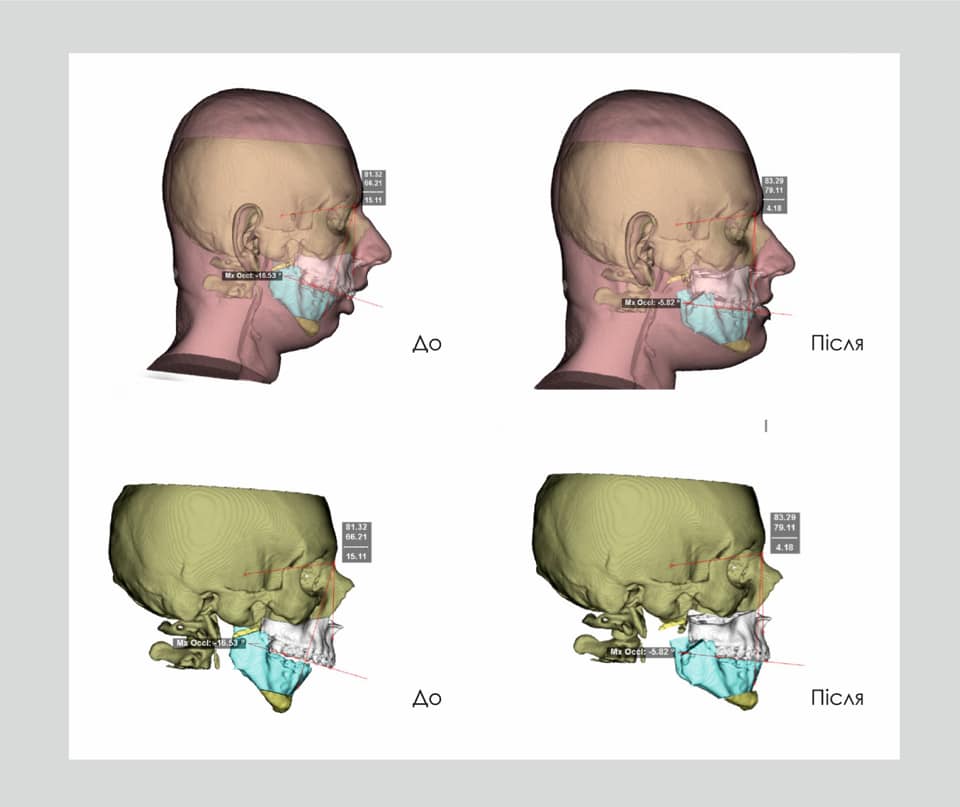Украинские врачи заново собрали лицо молодому парню: фото до и после