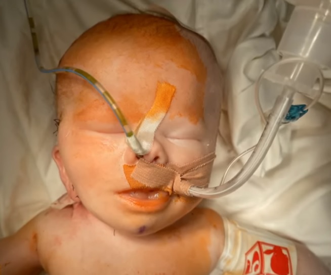 Была вдвое больше головы: в Украине врачи впервые удалили гигантскую опухоль у младенца