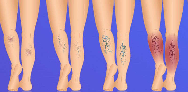 Лечение варикоза с гарантией результата от клиники «Институт Вен»