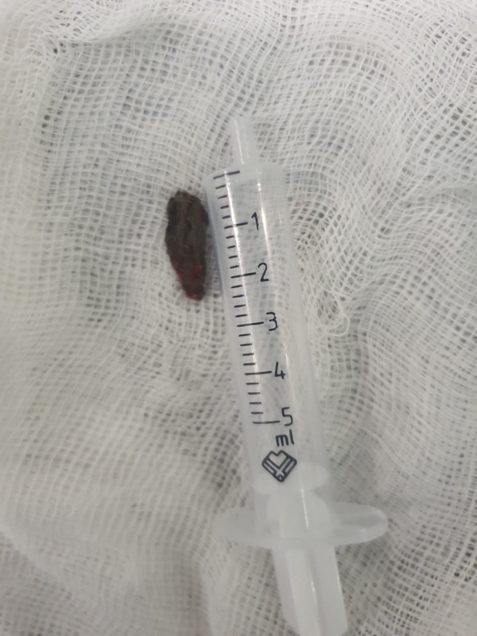 Такі операції у світі одиничні: у Дніпрі ювелірно дістали уламок з серця військового