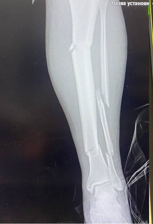 &quot;Всі, хто був поряд, полягли&quot;. Медики розчулили історією порятунку воїна