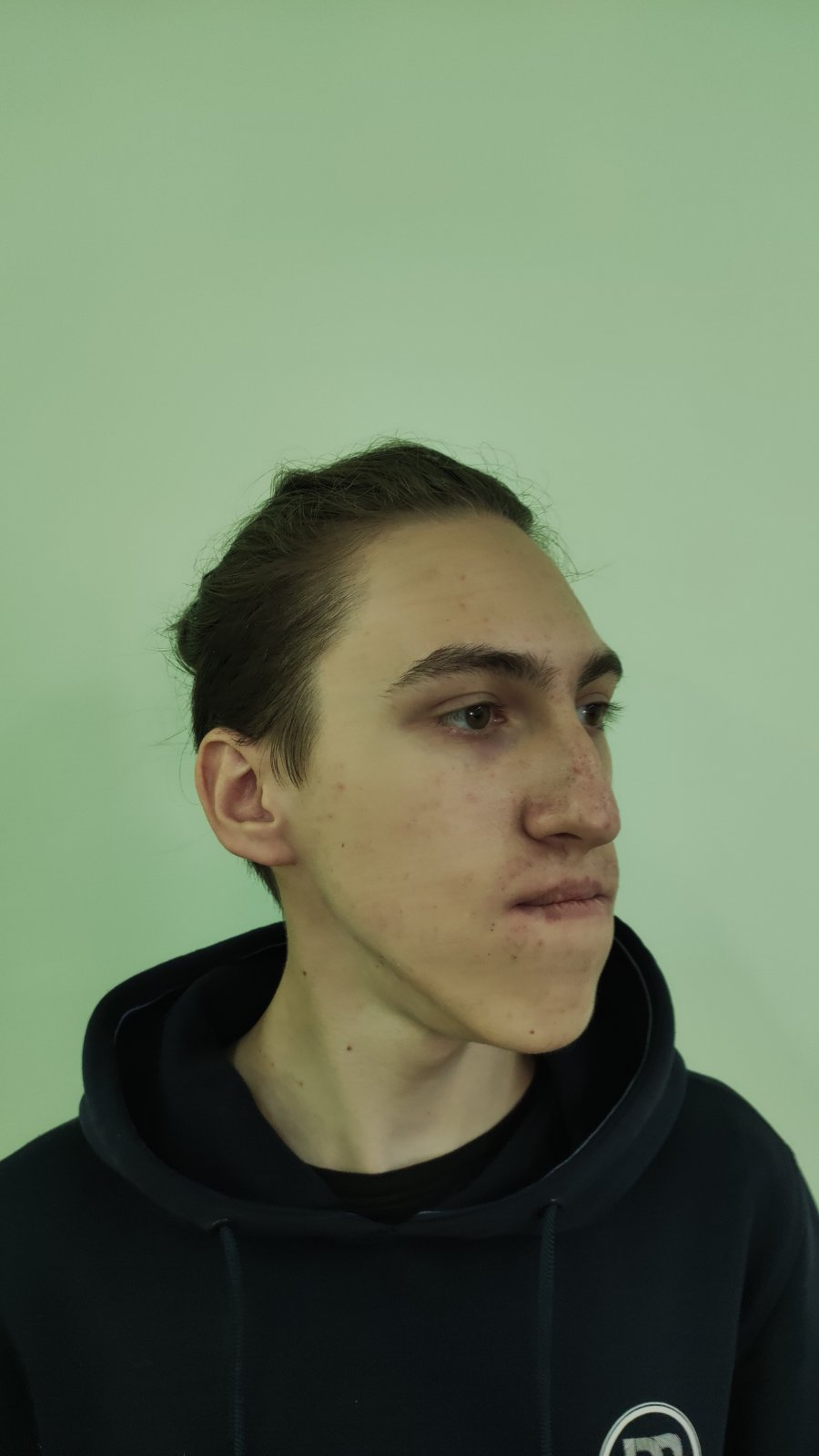 &quot;Сложили, как кубики лего&quot;: во Львове реконструировали лицо парню с тяжелым пороком