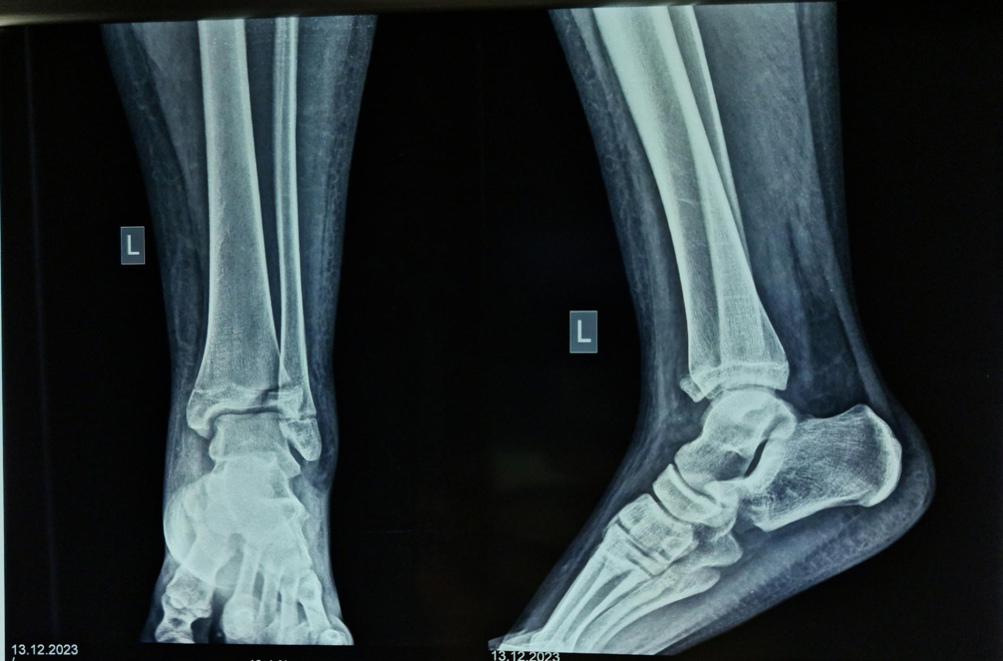 Не обращалась к медикам две недели: в Ровно у девушки обнаружили редкий перелом (фото)