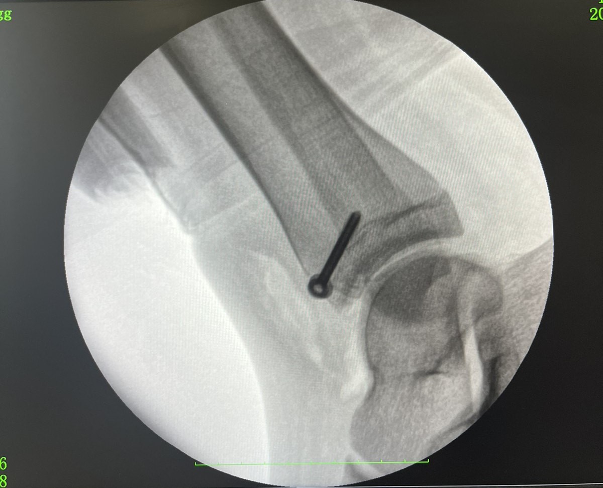 Не обращалась к медикам две недели: в Ровно у девушки обнаружили редкий перелом (фото)
