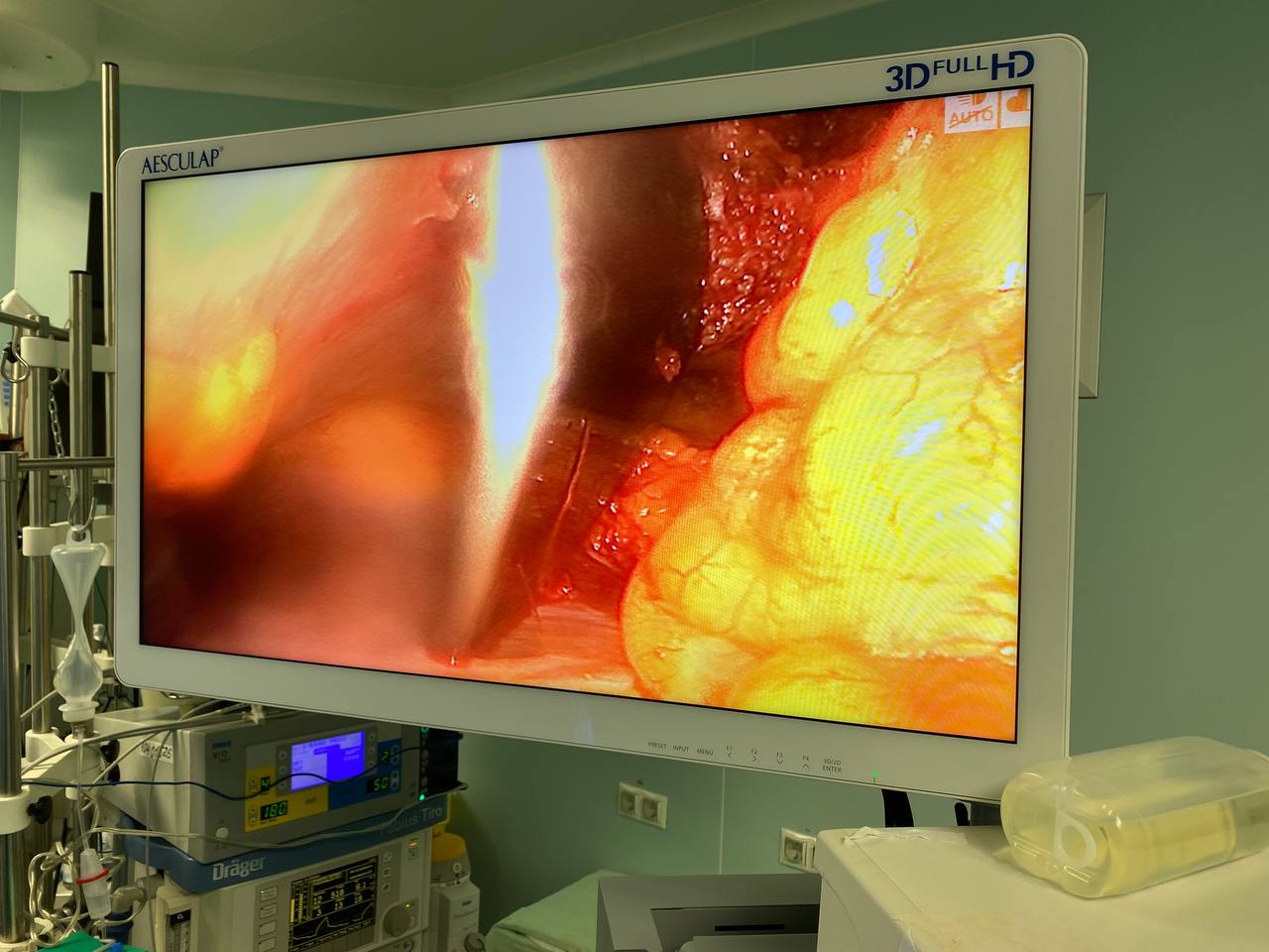 Могла в любой момент умереть: в Киеве у женщины обнаружили 12-сантиметровую кисту возле сердца