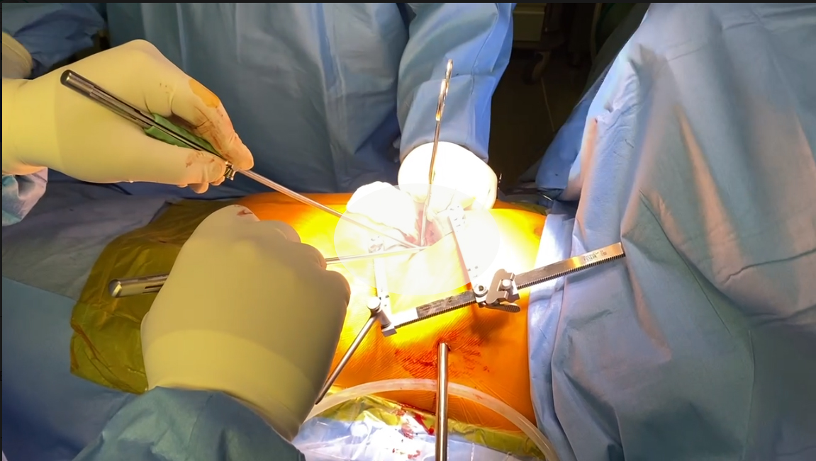 Могла в любой момент умереть: в Киеве у женщины обнаружили 12-сантиметровую кисту возле сердца