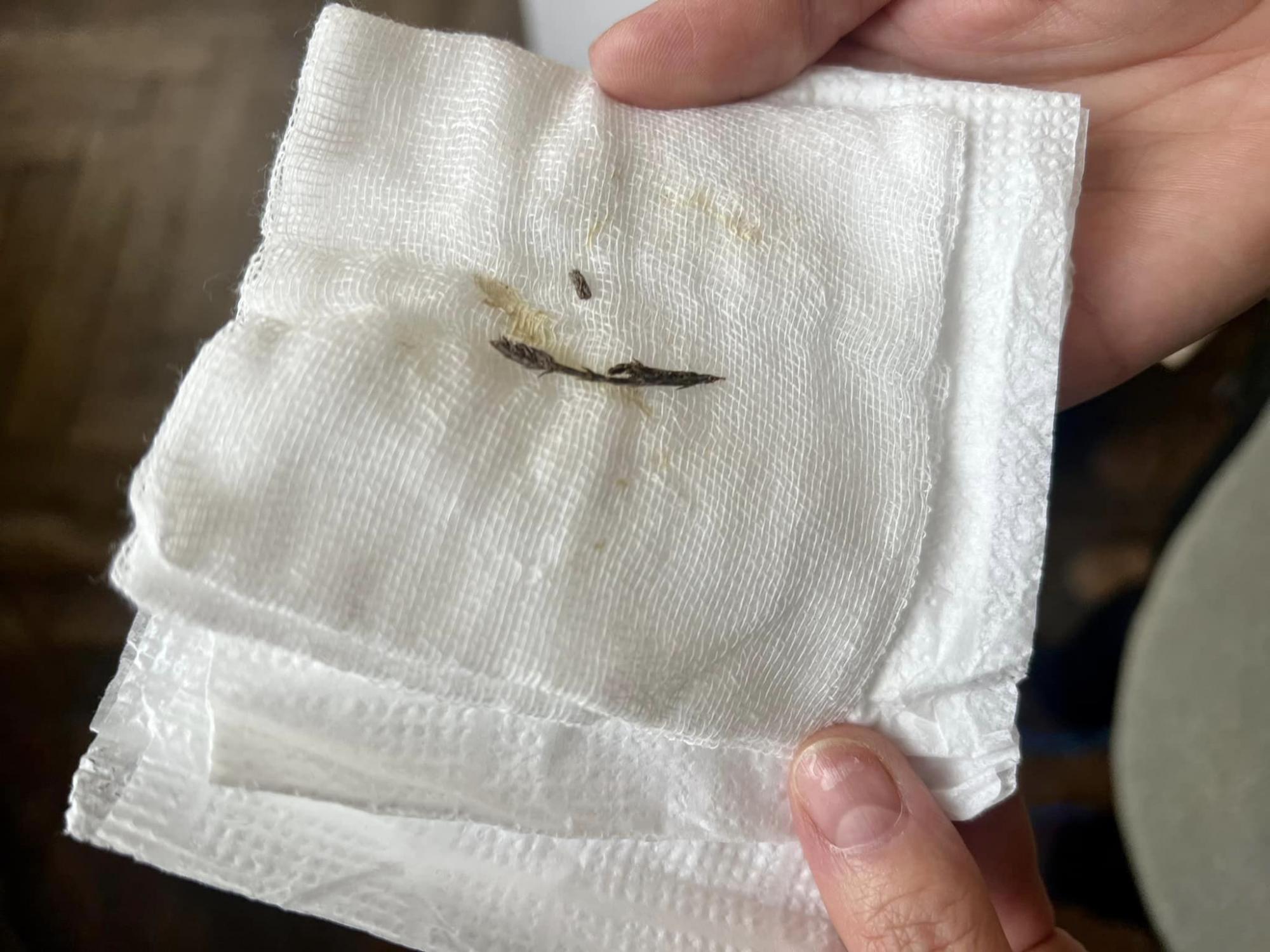 Полтора года не могли поставить диагноз: во Львове в бронхах мальчика нашли хвойную веточку