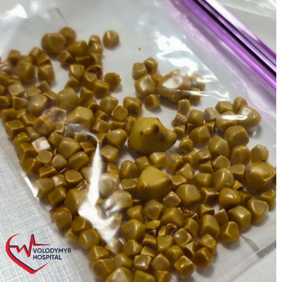 Видалили понад 100 камінців: на Волині врятували життя жінці