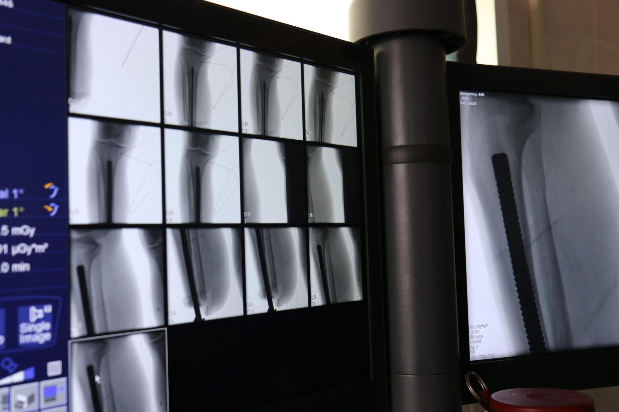 Эта методика инновационна для Украины. В Виннице провели уникальную операцию по протезированию