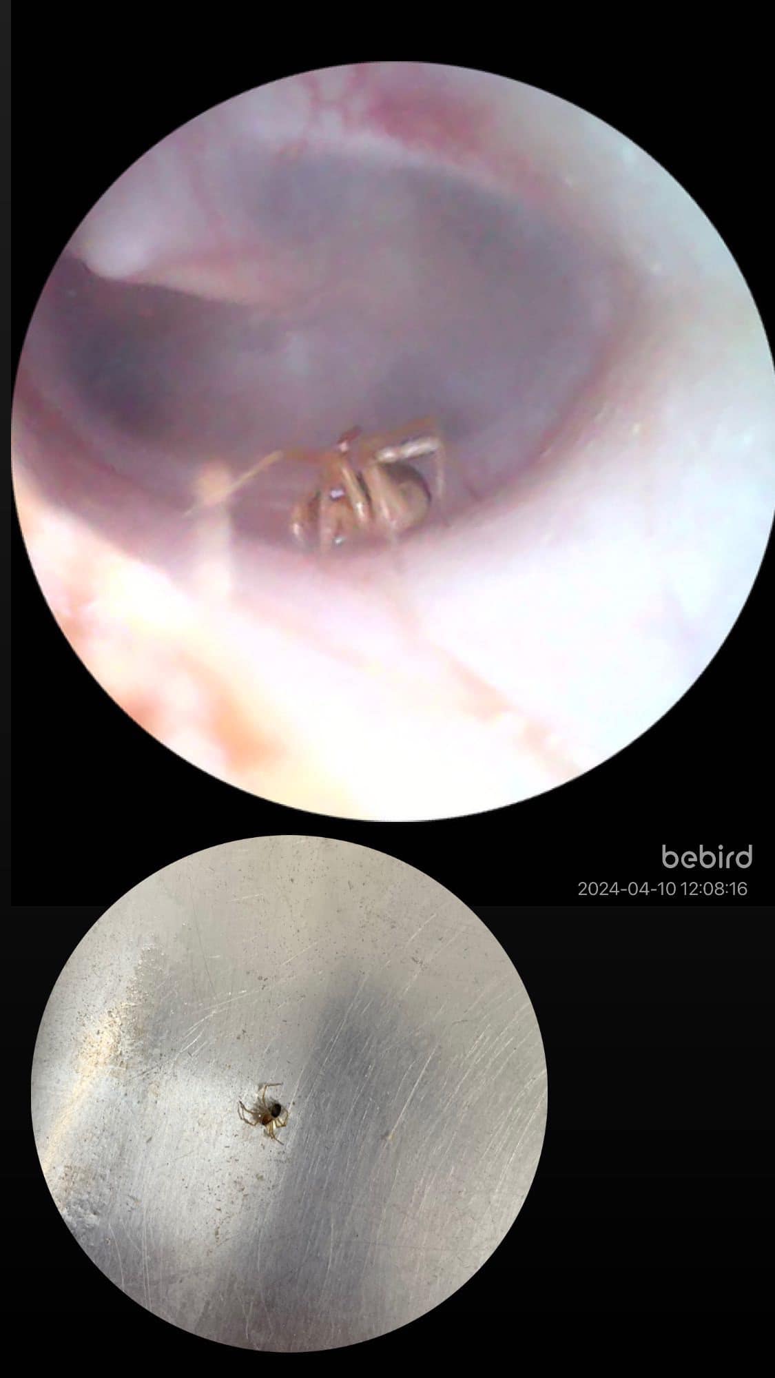&quot;Цікава знахідка&quot;: під Тернополем у вусі 4-річного хлопчика виявили павука