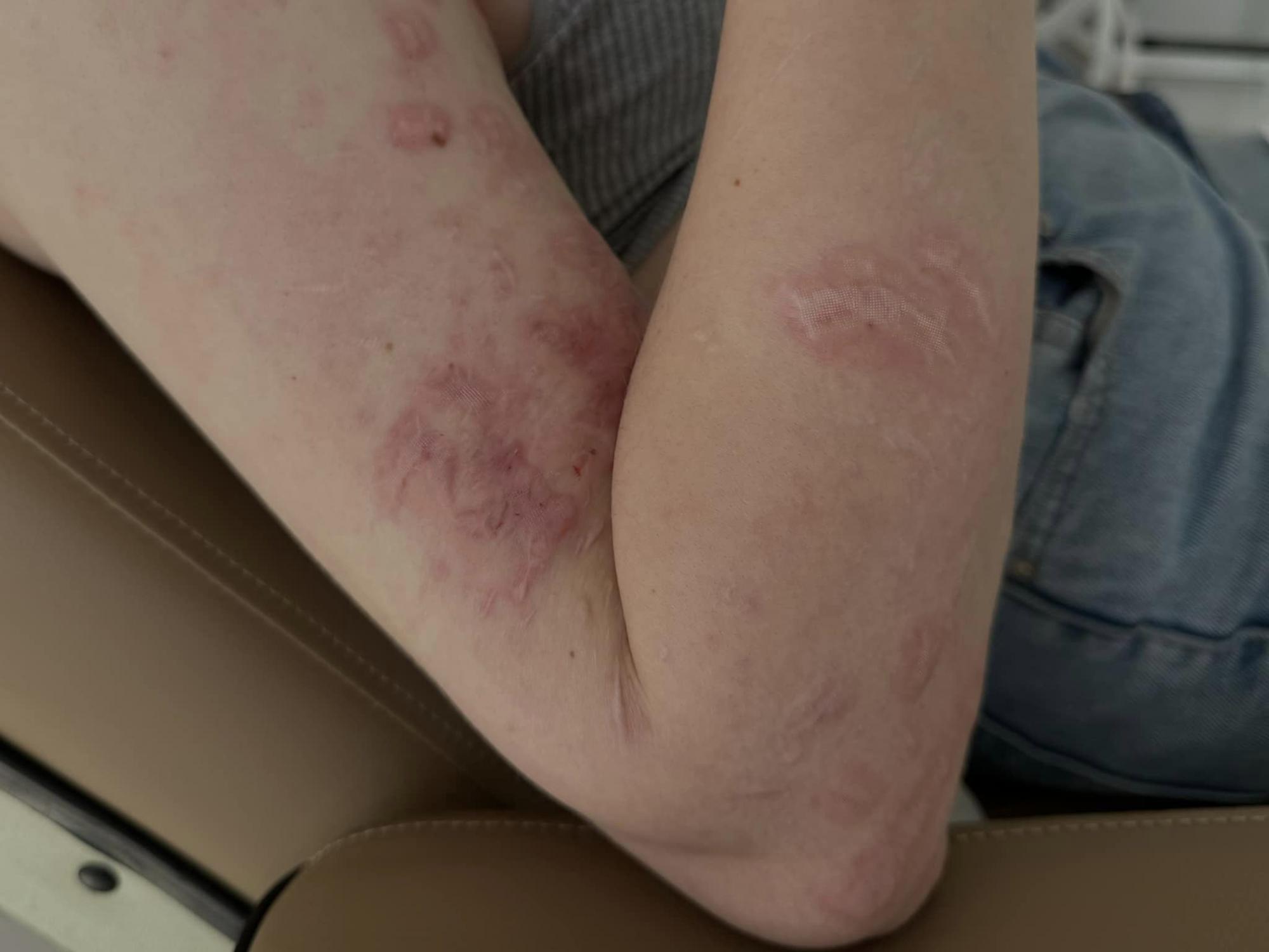 Ракета изувечила лицо: медики &quot;возвращают красоту&quot; 20-летней девушке перед свадьбой