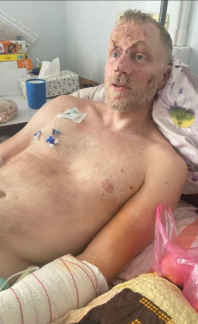 Контузия и зашитое лицо: известный актер получил ранение на фронте