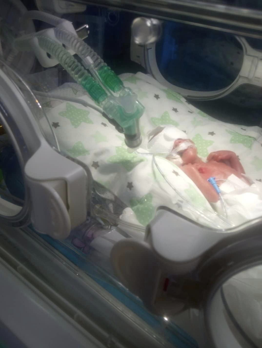 Була вага всього 570 г: у Львові за понад 100 днів врятували передчасно народжену Єву