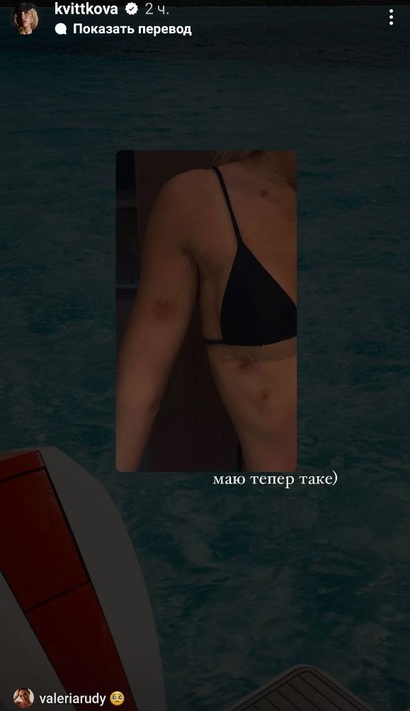 Даша Квиткова получила травму во время шикарного отдыха на яхте в Доминикане: фото последствий