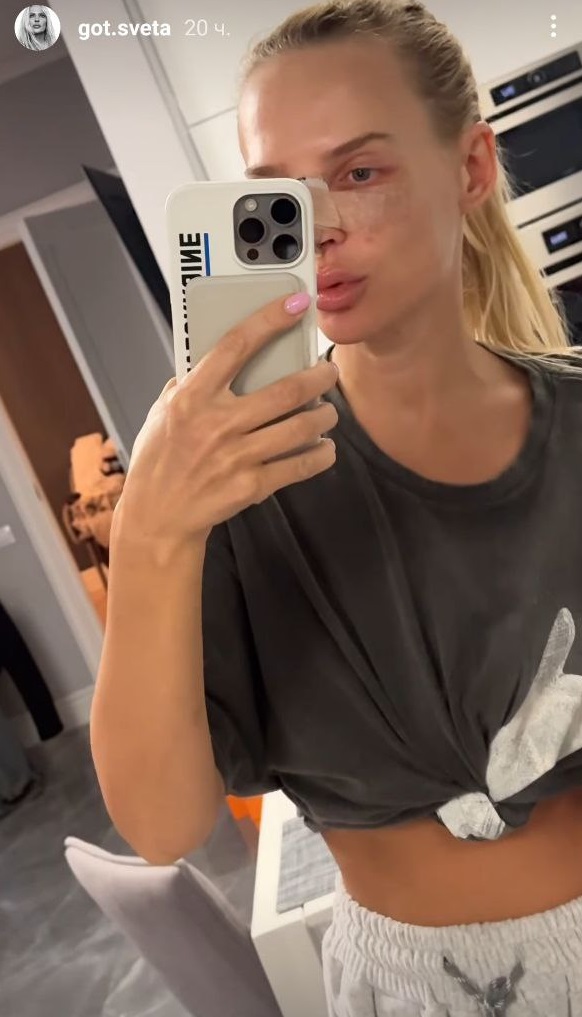 На фоне слухов о разрыве: избранница Цымбалюка сделала "пластику" и высказалась об актере