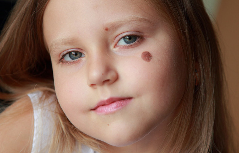 Родимки у дітей: які з них вас повинні насторожити