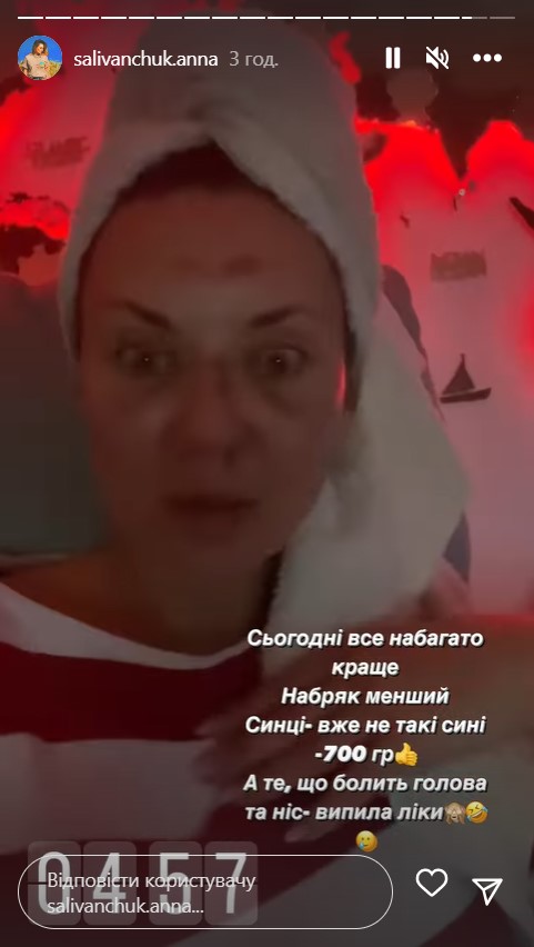 Зірка &quot;Квартала 95&quot; Саліванчук жахнула фото після перелому носа і струсу мозку