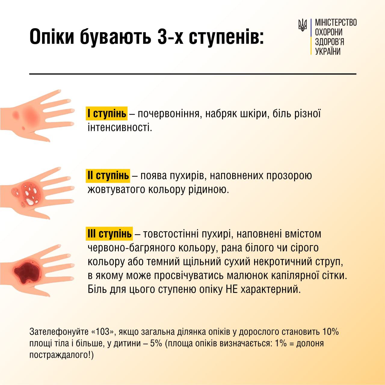 Як швидко допомогти при опіках: медики дали чіткий алгоритм дій