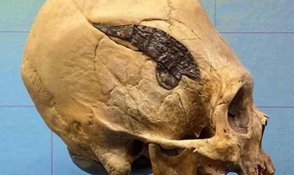 Археологи обнаружили древний череп со следами хирургической операции: ему более 2000 лет