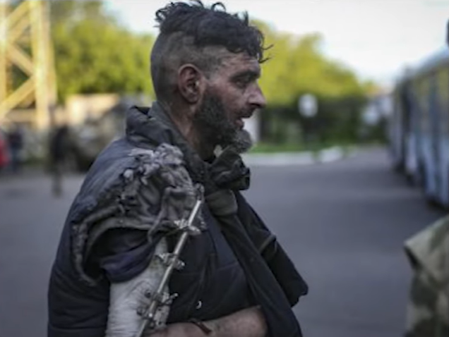 У героя Мариуполя после плена нет 4 см кости в руке. Украинцы начали сбор на лечение (фото)