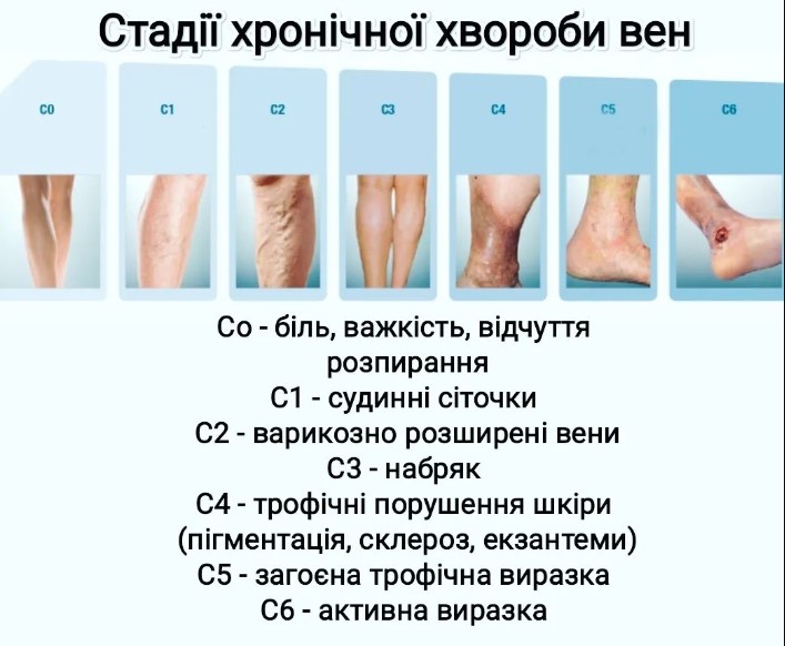 Стадії варикозу: коли можна пролікувати, а коли необхідна операція