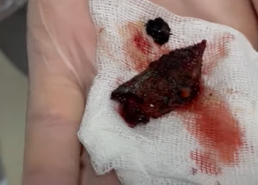 Лікарі врятували хлопчика з Бахмута з уламком російського снаряда, що застряг біля серця (відео)