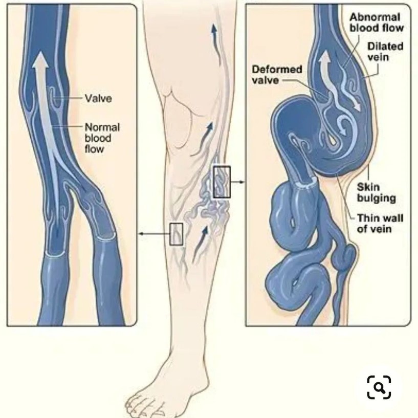 Косметичний недолік чи бомба сповільненої дії? Чим насправді загрожує варикоз