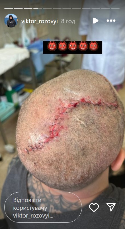 Комик Виктор Розовый раскрыл подробности реабилитации и вспомнил бой перед ранением (фото)