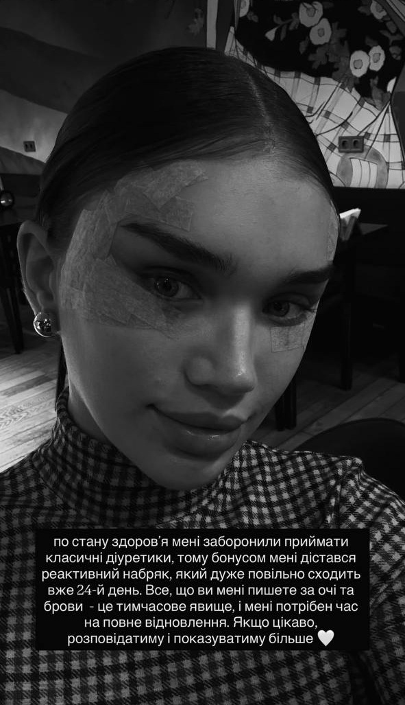 Саша Бо поскаржилася на ускладнення після омріяної &quot;пластики&quot;: фото до та після