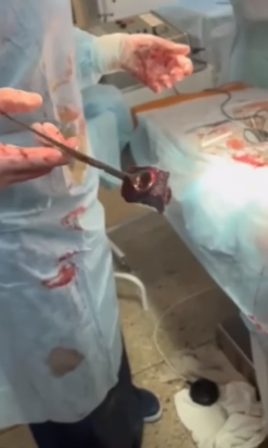 "З живої тканини йде дим": у Дніпрі лікарі рятують хлопця з тяжким пораненням