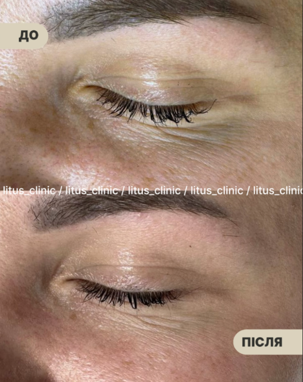 Ирина Литус: Exoxe, HP Cell Vitaran и Iuse Skin Booster HA20 - новая эра в профилактике старения кожи