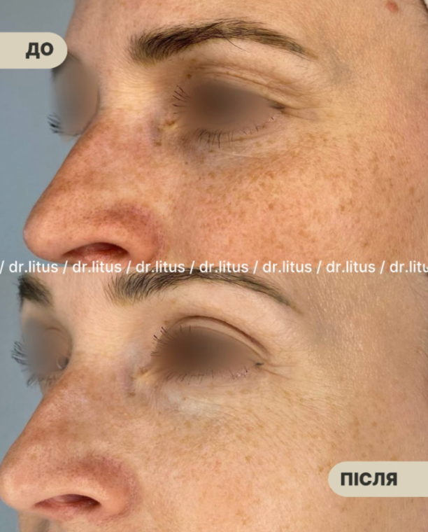 Ирина Литус: Exoxe, HP Cell Vitaran и Iuse Skin Booster HA20 - новая эра в профилактике старения кожи