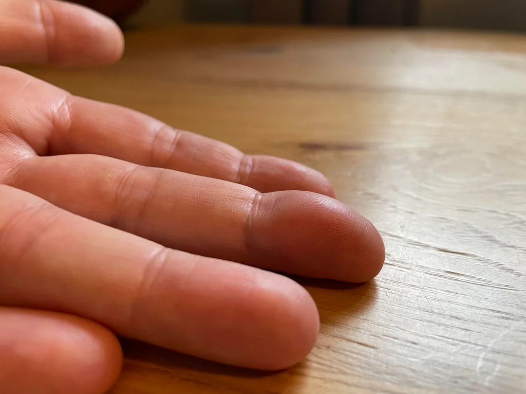 Шишка на пальце - женщина увидела нарост на руке и узнала о странном  диагнозе, фото | РБК Украина