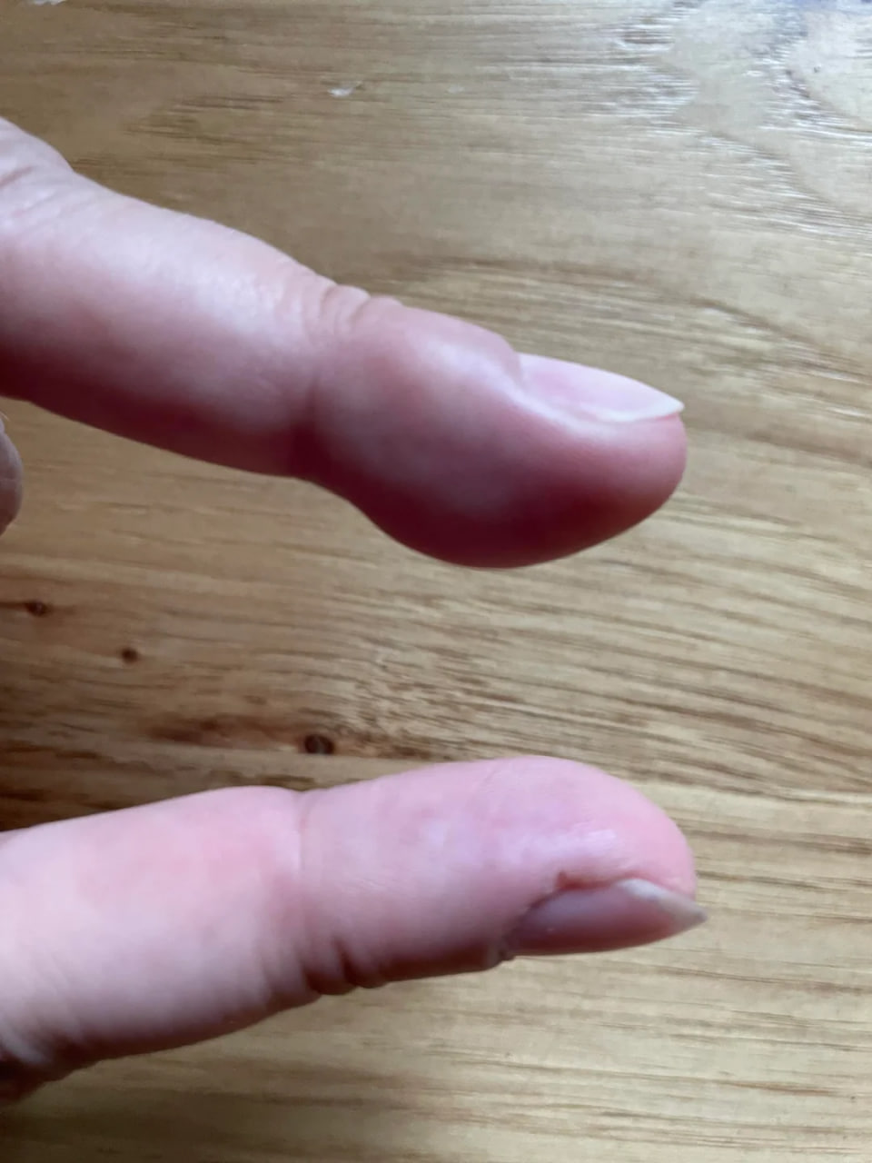 Шишка на пальце - женщина увидела нарост на руке и узнала о странном  диагнозе, фото | РБК Украина