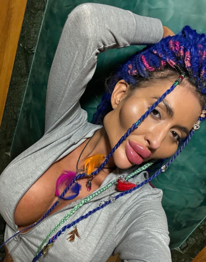 Українка з найбільшими вилицями зробила ще одну &quot;пластику&quot; та показалася після наркозу (фото)