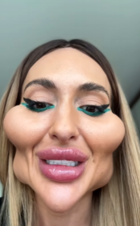 &quot;Кожа болтается&quot;: украинка с самыми большими скулами похудела на 12 кг и перенесла еще одну &quot;пластику&quot;