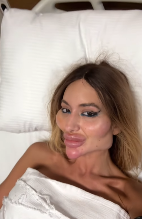 &quot;Кожа болтается&quot;: украинка с самыми большими скулами похудела на 12 кг и перенесла еще одну &quot;пластику&quot;