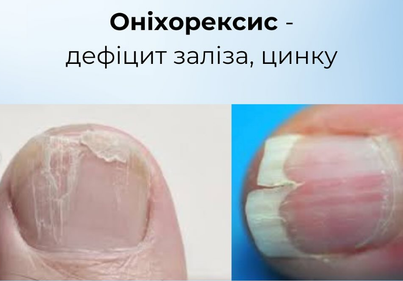 На проблему вкажуть нігті: як розпізнати харчові дефіцити й повернути собі здоров'я