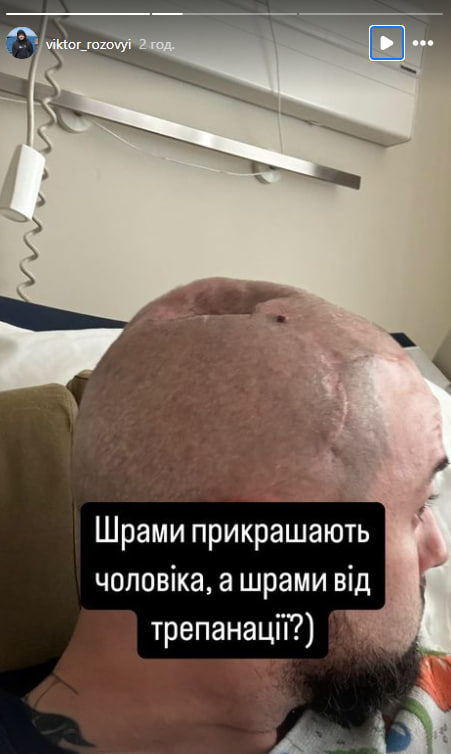 Звезда &quot;Ліги сміху&quot; Розовый показал шрамы от трепанации после ранения на фронте (фото)
