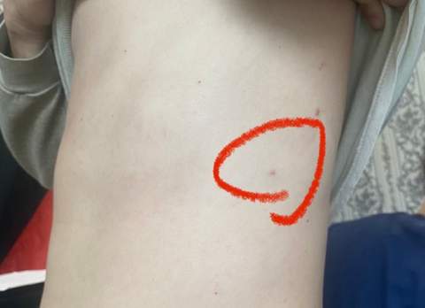 Боец ВСУ три недели воевал со сломанным хребтом. Врачи были шокированы