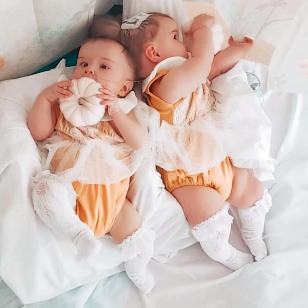 Українка народила зрощених близнюків, яким давали мінімальні шанси вижити: як вони виглядають зараз